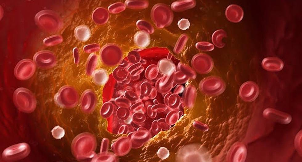 COVID-19 increases the risk of thrombotic events months after infection, according to a study