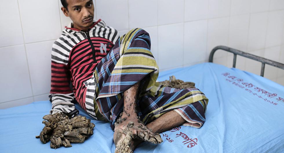 Abul Bajandar, un paciente con epidermodisplasia verruciforme, recibe atención médica en un hospital de Bangladesh. (Foto: EFE)