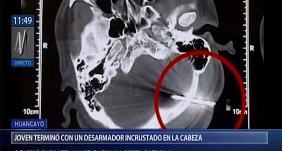 Perú. Joven terminó con desarmador incrustrado en la cabeza tras pelea en fiesta patronal en Junín. (Foto: Canal N)