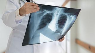 Salud | Revelan el mecanismo que hace que la tuberculosis sea tan peligrosa