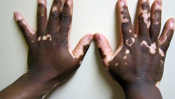 El vitiligo es una enfermedad que es provocada por distintas razones. (Foto: Referencial)