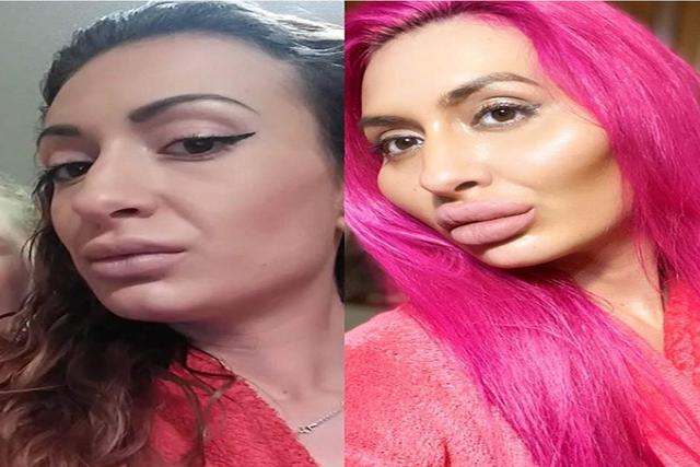 FOTO 1 DE 3 | El antes y después de Anastasiia Pokreshchuk, tras someterse a varias inyecciones de relleno facial en los pómulos y labios. | Crédito: _just__queen_ en Instagram. (Desliza hacia la izquierda para ver más fotos)