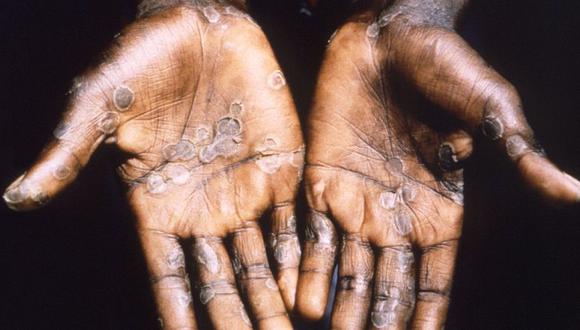Las palmas de las manos de un paciente con viruela del simio de Lodja, una ciudad ubicada dentro de la Zona de Salud de Katako-Kombe, se ven durante una investigación de salud en la República Democrática del Congo en 1997.