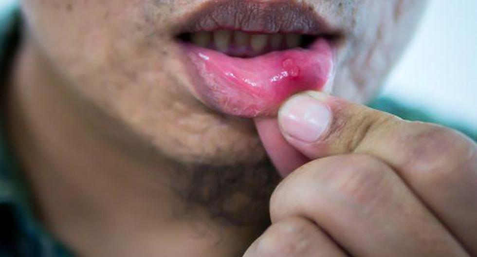 Combate esa molesta herida en tu boca con estos siete remedios. (Foto: Getty Images)