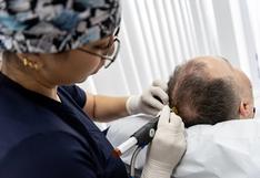 Calvicie o alopecia: ¿cómo impedirla y qué opciones médicas existen? 