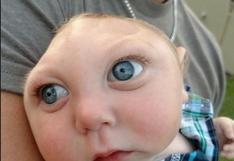 Jaxon Buell, el bebé que nació sin parte de su cerebro 