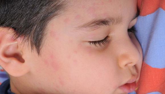 Los niños en edad escolar están en particular riesgo de contraer el sarampión. (Foto: Getty Images)