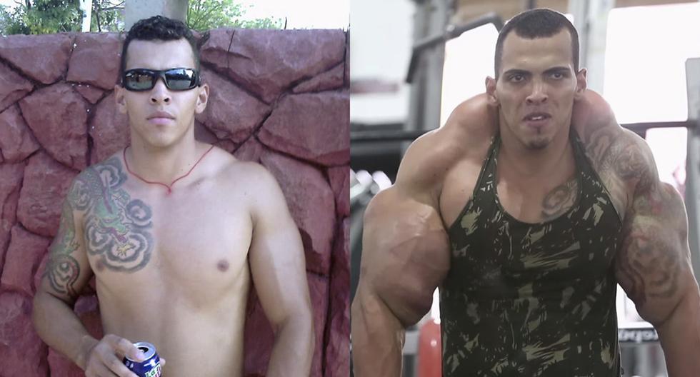 Romario Dos Santos Alves de 25 es un ciudadano Brasileño que tras años de inyectarse Synthol en los brazos quedo así.