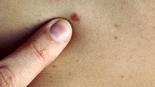 Cáncer de piel: seis señales para identificar esta enfermedad
