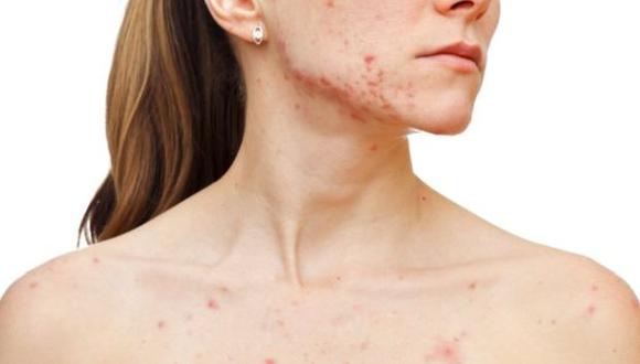 Aunque no existe una cura para el acné, sí se puede controlar con tratamientos.