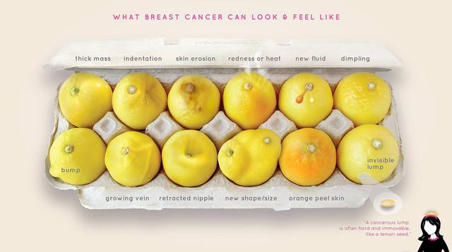 Cáncer de mama: Los limones que ayudan a entender las señales - 1