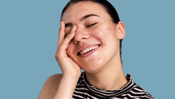 El acné adulto es una condición de la piel que se produce cuando los poros se obstruyen y se inflaman, lo que puede provocar la aparición de granos, espinillas y puntos negros en personas mayores de 25 años.