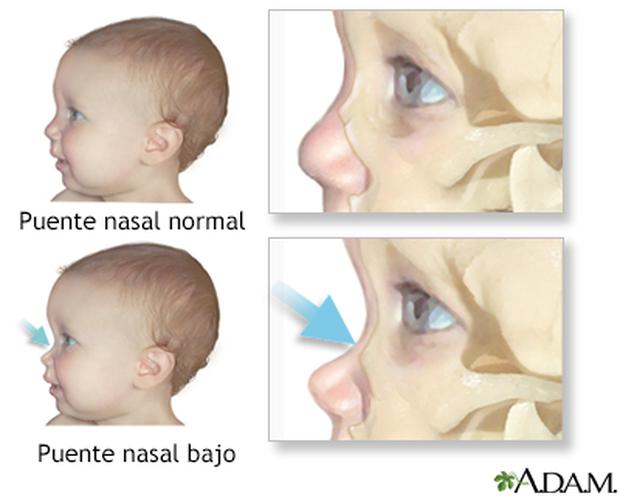 El puente nasal bajo es una característica física de los pacientes con Síndrome de Williams. (Imagen: A.D.A.M.)