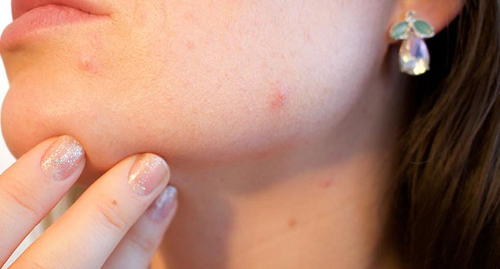 El acné suele aparecer en varias partes del cuerpo. (Foto: Pixabay)