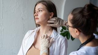 Día del Lunar: ¿Cómo prevenir el cáncer de piel por medio de un examen de los lunares?