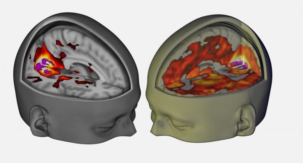 Una nueva técnica de neuroimagen muestra los efectos que produce el LSD en los cerebros de los seres humanos. (Foto: Imperial College LondoN)