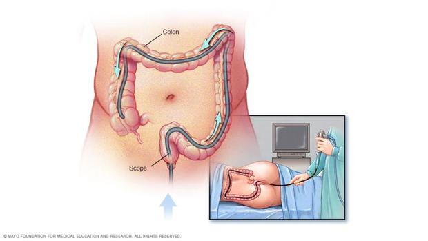 La colonoscopia consigue observar la mucosa de todo el colon a través de un tubo largo y flexible (endoscopio) que se introduce por el ano. (Foto: Mayo Clinic)