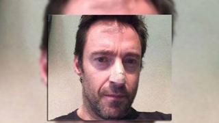 Hugh Jackman revela en Instagram que padece un carcinoma en la nariz