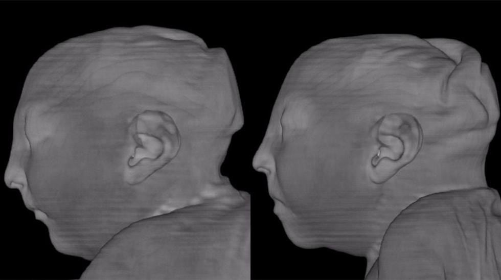 La deformaci&oacute;n de los cerebros de dos gemelos afectados por el virus zika. (Revista Radiology)