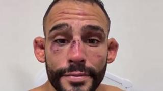 Dura derrota de Ponzinibbio: así quedó su rostro tras combate con Michel Pereira | VIDEO
