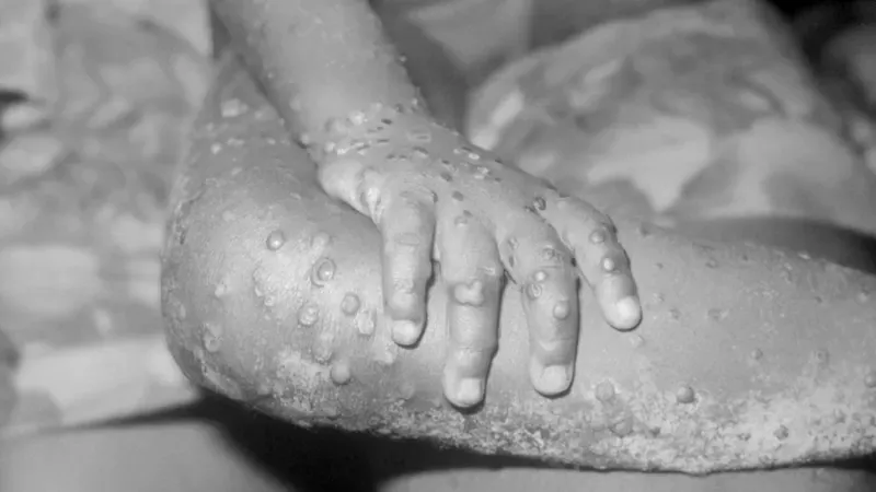 In the case of monkeypox, the rash usually starts on the face and then spreads to other parts of the body.  (GettyImages).