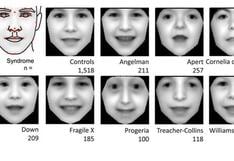 Trastornos genéticos se diagnosticarán con fotos gracias a software 
