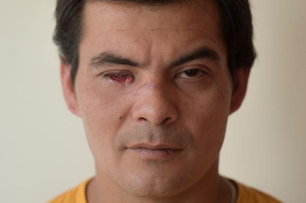 Luis Hernando Rodríguez, wounded in the eye by a non-lethal weapon, poses during an interview with AFP in Bogotá, on September 17, 2021. (Juan Barreto / AFP).