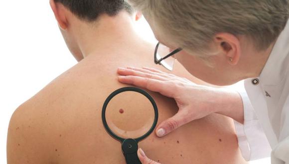 El cáncer de piel es el tipo de cáncer más común en el mundo. (Foto referencial: Shutterstock)