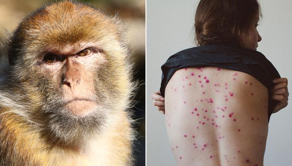 La rápida propagación de la viruela del mono se da siempre y cuando el individuo haya estado en contacto con otra persona infectada con este virus, señala el especialista. (Foto: Difusión)