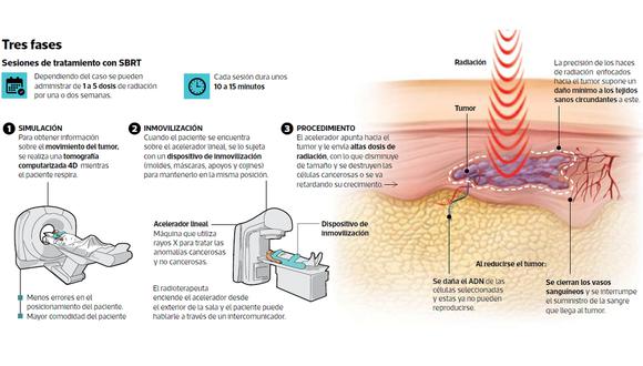 Infografía sobre la radioterapia estereotáctica del cuerpo. Infografía: Jean Izquierdo / El Comercio
