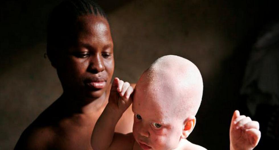 Otro niño albino es asesinado en Tanzania. (Foto: reportersmagazine.com)