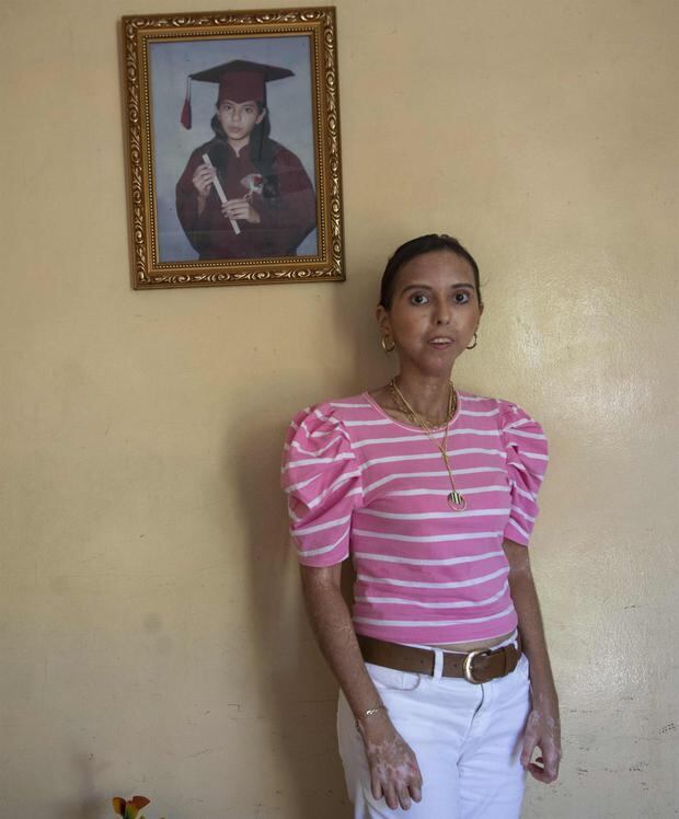 Nathaly Cerda La Joven Nicaragüense A Quien Le Dieron Dos Años De Vida Y 13 Años Después Vive 