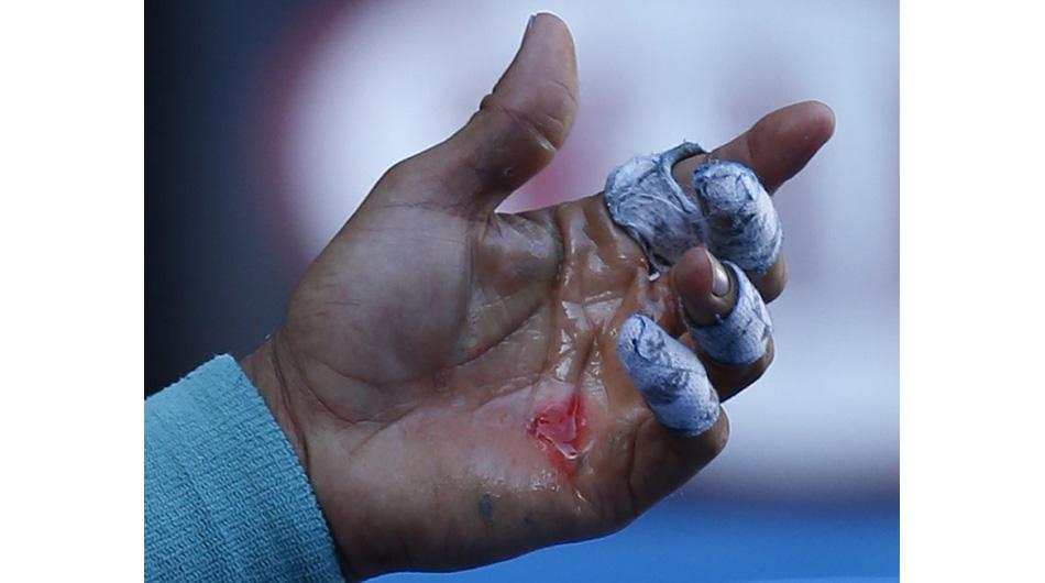 Rafael Nadal jugará con una mano herida ante Roger Federer - 1
