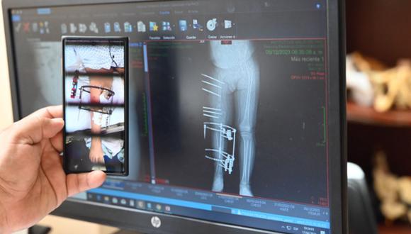 Médicos del Servicio de Traumatología del INSN salvaron la pierna derecha de un pequeño que sufrió un grave accidente cuando tenía apenas un año | Foto: INSN