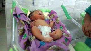 Chimbote: un bebe nació con dos narices y necesita ayuda