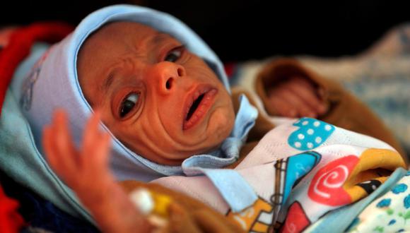 Vista de un niño con desnutrición en un hospital de la ONU en Saná, Yemen. Se proyecta que más de dos millones de niños y un millón de mujeres embarazadas y madres sufrirán malnutrición severa este 2021 en el país. (Foto: Yahya Arhab / EFE)