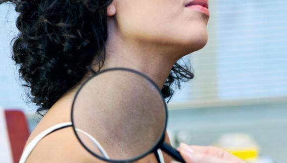 Vitiligo: Entérate más sobre este trastorno dermatológico