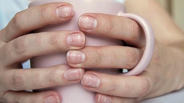 In certain cases, horizontal white spots may appear on the nails.  Generic photo.