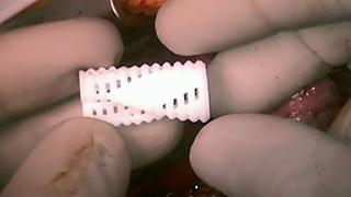 Implantes impresos en 3D salvan la vida de 3 bebés