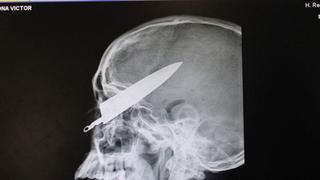 Joven trujillano apuñalado en la cabeza fue operado