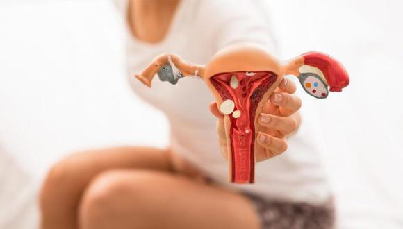 Endometriosis: Conoce de qué se trata esta enfermedad que afecta exclusivamente a las mujeres, y cómo se puede detectar a tiempo a propósito de la operación a la que fue sometida Magdyel Ugaz. (Foto: VITA)
