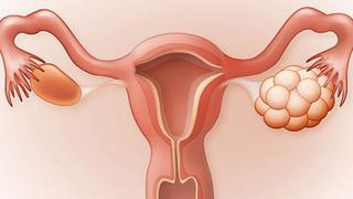 Síndrome de Ovario Poliquístico: ¿qué efectos tiene sobre mi cuerpo?
