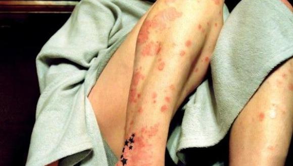 Los síntomas son placas rojas en la piel y uñas.