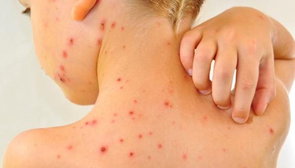 Los niños son los más proclives a contagiarse de sarampión. (Foto: ANDINA/Difusión)