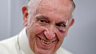 El papa Francisco se ríe del golpazo que le dejó el ojo morado en Colombia [FOTOS]