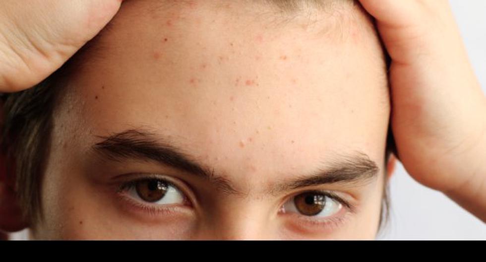 Importantes datos acerca del acné. (Foto: Wellnessjunky.com)