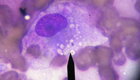 Imagen referencial de una célula maligna. (Foto: Reba_Tumor_Cell / Flickr bajo licencia Creative Commons)