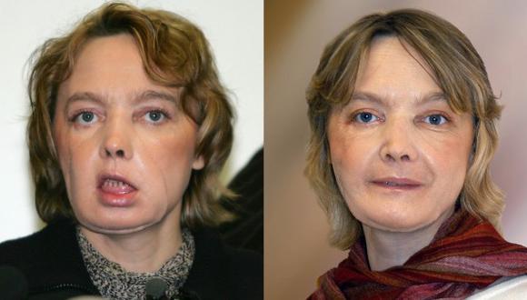 Isabelle Dinoire. La imagen de la izquierda fue tomada en febrero de 2006 y la otra, en noviembre de ese mismo a&ntilde;o. (AFP)