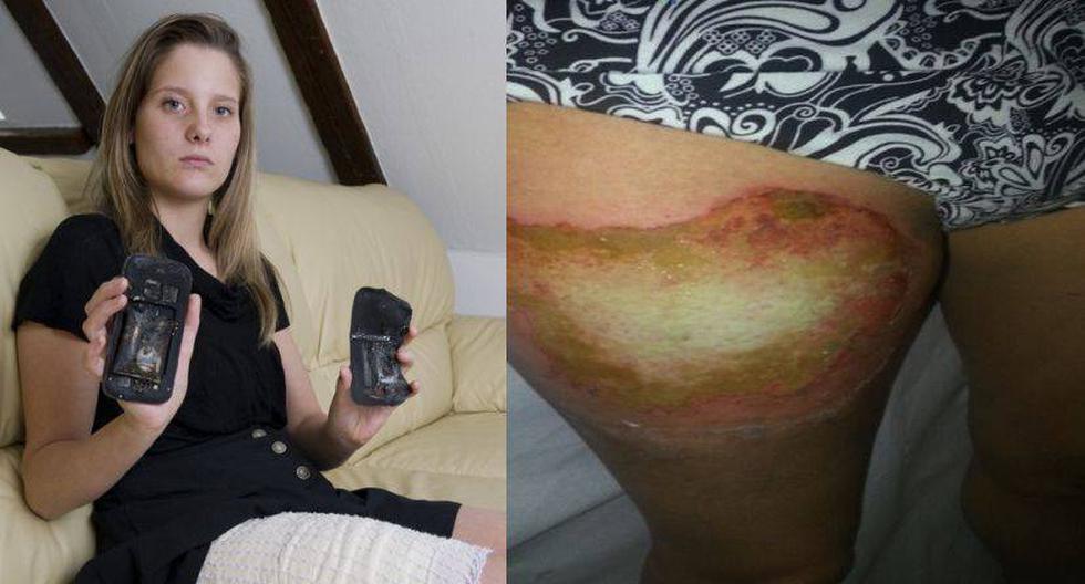 La adolescente de 18 años sufrió una quemadura en su pierna. (Foto: lematin.ch)