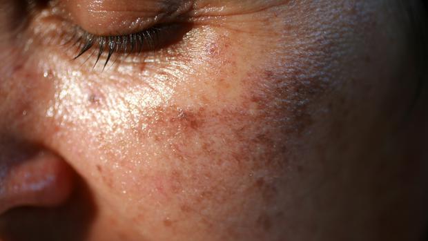 El protector solar ayuda a prevenir la aparición prematura de manchas y arrugas en la piel.